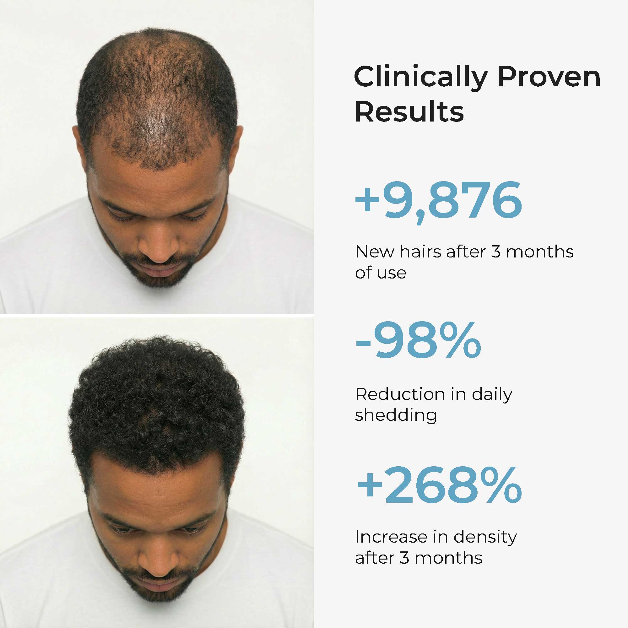 Micro Infusion Hair Regrowth Protocol