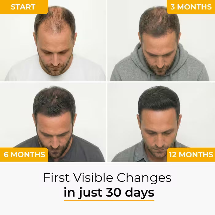 The Most Advanced Hair Regrowth Protocol - FolliGen-X® Formula Micro Infusion System