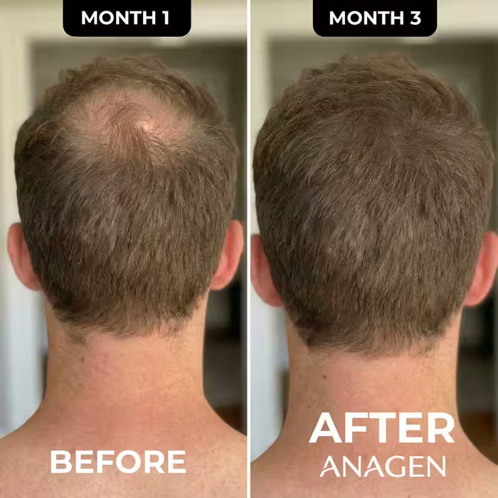 The Most Advanced Hair Regrowth Protocol - FolliGen-X® Formula Micro Infusion System