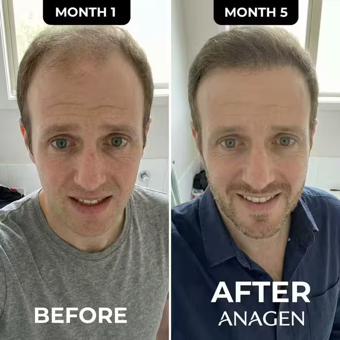 The Most Advanced Hair Regrowth Protocol - FolliGen-X® Formula Micro Infusion System